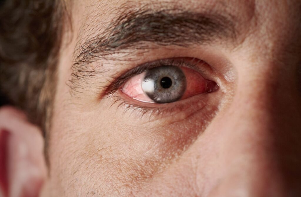 Close-up of the eye of a person suffering from pink eye or a similar condition