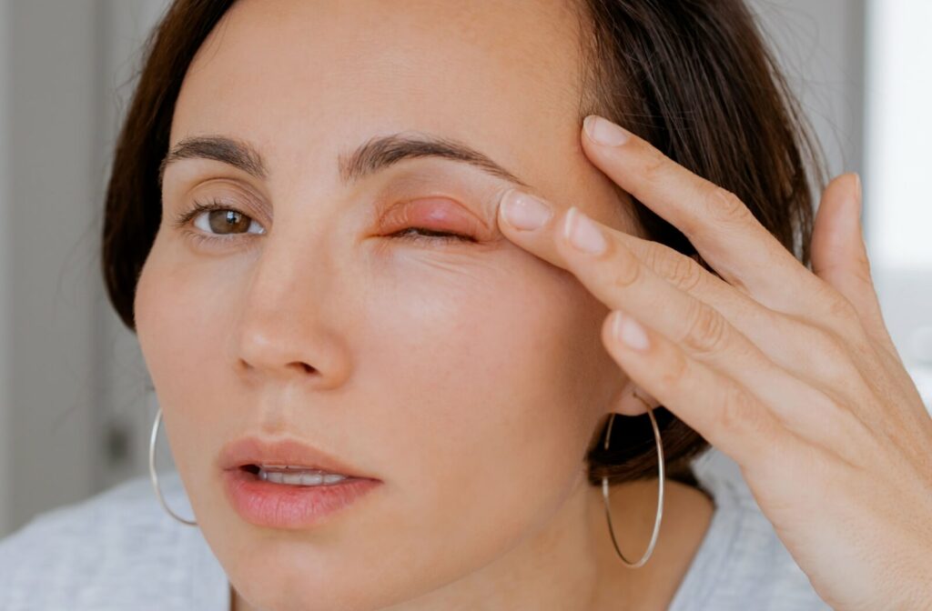 A person gently examines the red stye on their upper eyelid.