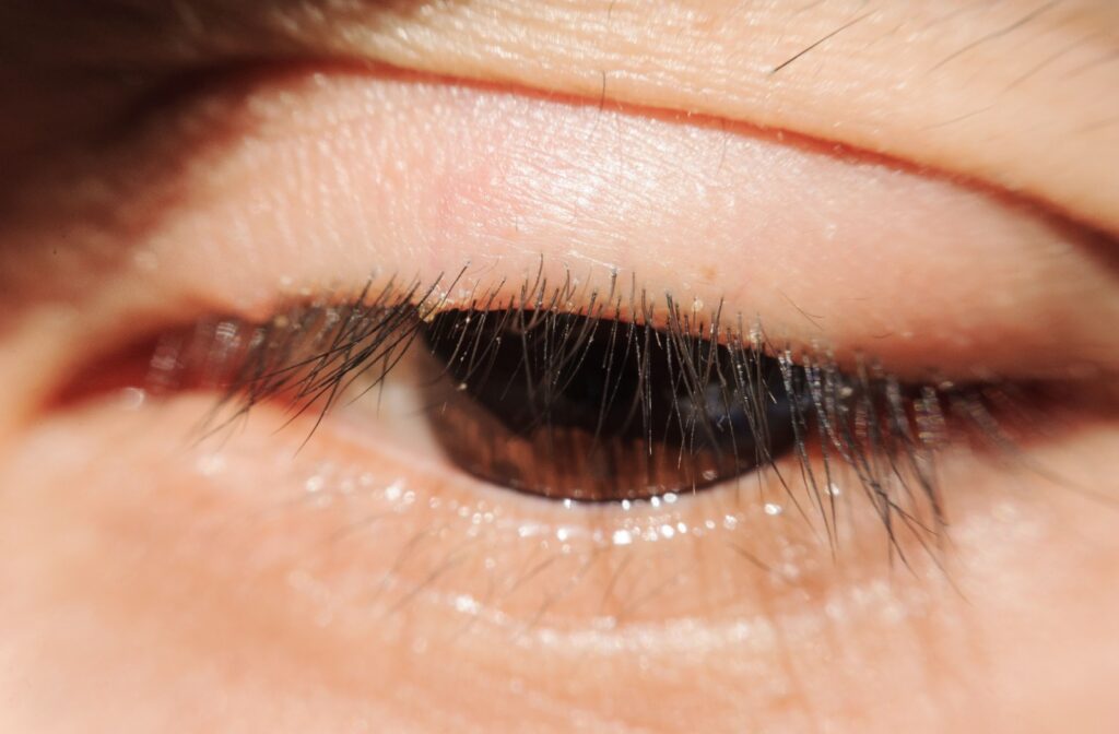 A close-up image of a person's eyes with blepharitis, showing signs of irritation.