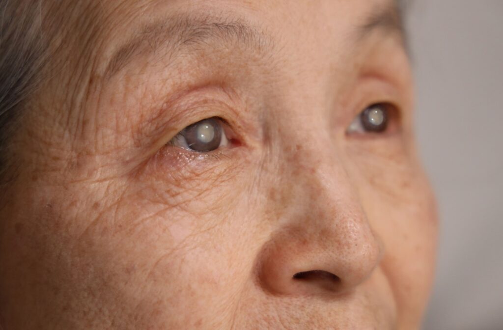 Close up of senior person with clouding in eyes representing cataracts.